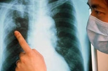 В Набережных Челнах пятерых туберкулезников заставили лечь в больницу